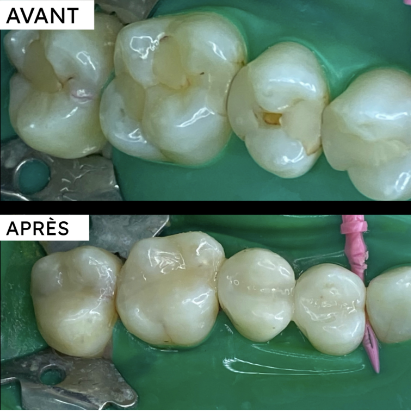 Page restauration caries dents postérieures_avant-apres