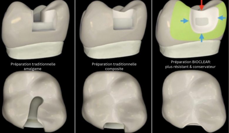 Page Caries postérieures_petit diagramme La nouvelle façon de soigner les caries : restaurations des dents postérieures